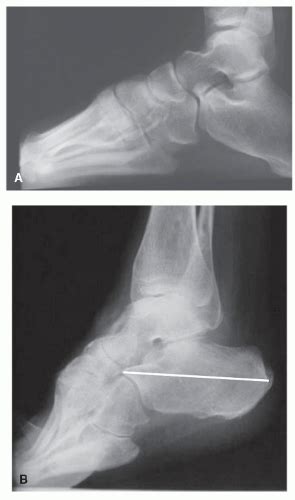 Pes Cavus Surgery | Musculoskeletal Key