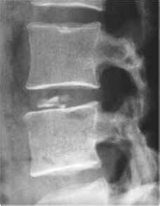 Disc Calcification - Syndrome Omim - RR School Of Nursing