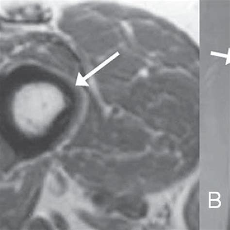 A: Lamellar periosteal reaction on the medial aspect of the tibial ...