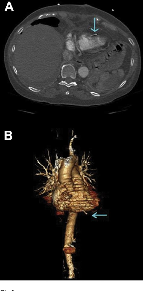 Figure 2 from Transventricular migration of an inferior vena cava filter limb. | Semantic Scholar