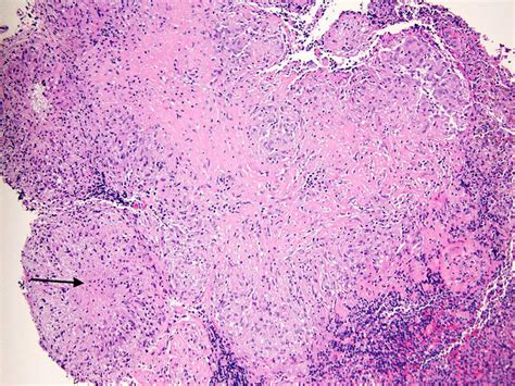 Necrotizing granulomatous inflammation involving lymph node tissue ...