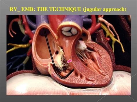 Endomyocardial Biopsy