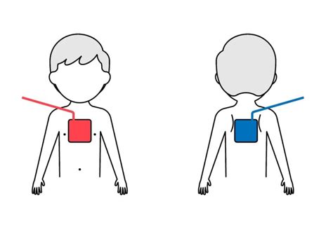 Automated External Defibrillator Pad Placement