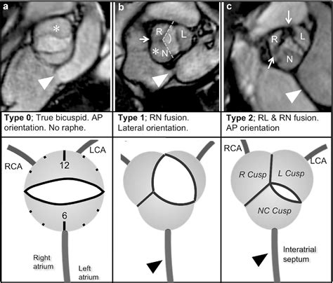 Comprehensive 4-stage categorization of bicuspid aortic valve leaflet ...