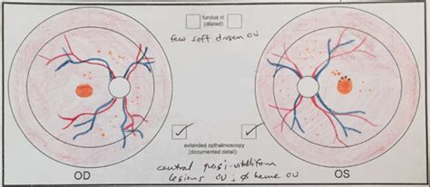 My efforts as an artist: learning to draw the retina — Matt Weed, MD ...