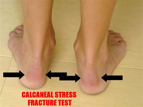 Got Kids? It's Important to Know the Difference Between Plantar Fasciitis and Calcaneal Stress ...