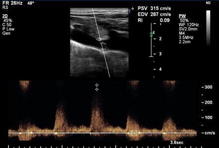 Subclavian steal syndrome - on ultrasound | Image | Radiopaedia.org ...