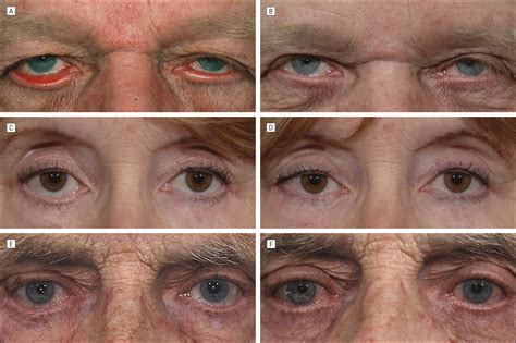 The Lateral Tarsal Strip Mini-Tarsorrhaphy Procedure | JAMA Facial ...