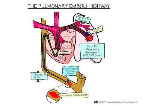 Diagnosis: Nursing Diagnosis For Pulmonary Embolism