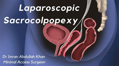 Laparoscopic Sacrocolpopexy for Vaginal Vault Prolapse | Dr. Imran Abdullah Khan - YouTube