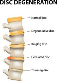 Bulging Disc Symptoms, Causes and Treatments Options