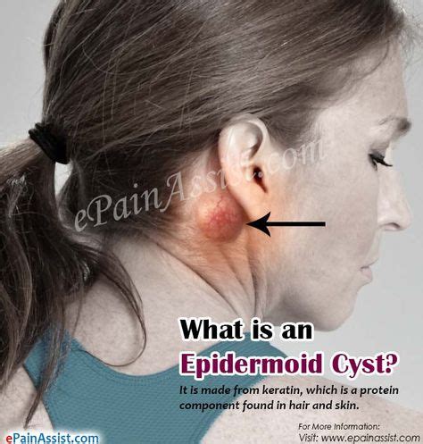 What is an Epidermoid Cyst? | Epidermoid cyst, Fatty cyst, Ear infection