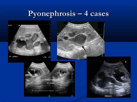 Renal inflammatory disease