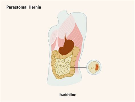 Parastomal Hernia: Symptoms, Repair, and Complications