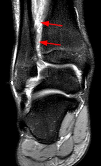 MRI Musculo-Skeletal Section: High ankle sprains.