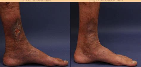 Venous Ulcers El Segundo CA - Venous Ulcers Los Angeles