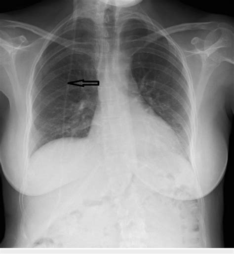 Chest X-ray Black arrow demonstrates ventriculoperitoneal shunt ...