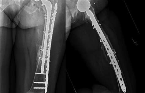 Follow-up films 6 months after hemiarthroplasty/plate fixation ...