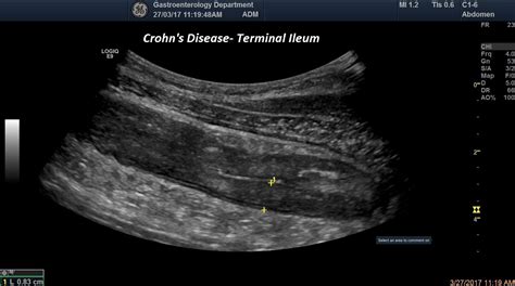 Terminal Ileitis [1 image] – EFSUMB