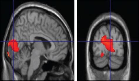 T1 MRI superimposition showing the cluster of voxels in the cuneus ...