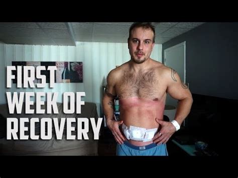 Hernia Surgery Recovery First Week - What to expect - YouTube