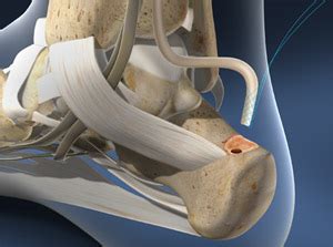 Tendon Transfer (FHL to Achilles)