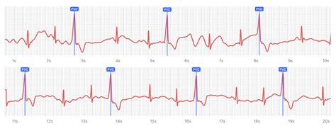 What Ventricular Trigeminy Looks Like on Your Watch ECG | Qaly