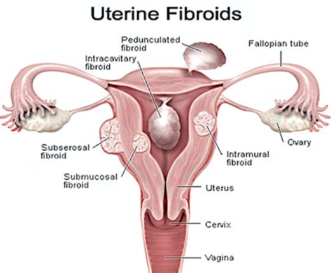 Fibroids - Philippe de Rosnay