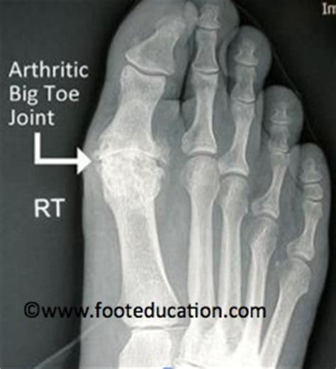 Hallux Rigidus (Big Toe Arthritis) - FootEducation