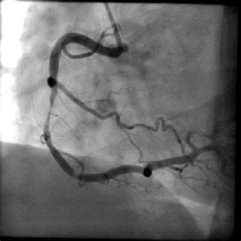 Coronary Angiography - Concord Cardiology