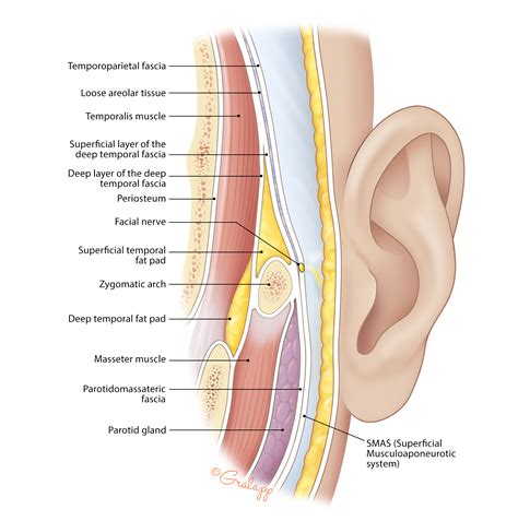 Preauricular Cyst Excision – Oto Surgery Atlas