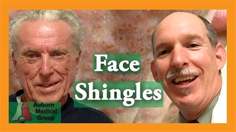 Face Shingles Treatment | Auburn Medical Group - YouTube