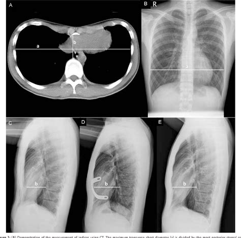 Figure 1 from Usefulness of chest images for the assessment of pectus excavatum before and after ...