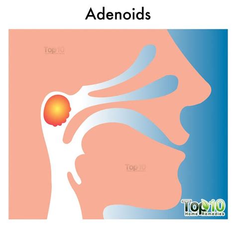 Home Remedies for Enlarged Adenoids in Children | Top 10 Home Remedies