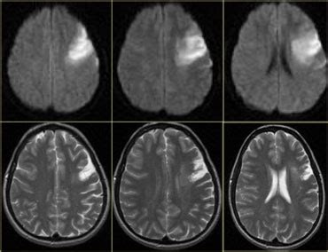 Stroke Brain Mri