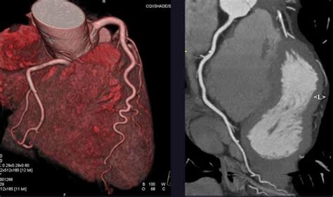 IMAGING GUIDED EUFLEXXA INJECTION FOR MANAGEMENT OF KNEE OSTEOARTHRITIS ...