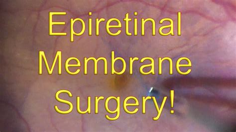 Epiretinal membrane surgery: Vitrectomy with ERM (Macular Pucker) peeling - Dr Simon Chen - YouTube