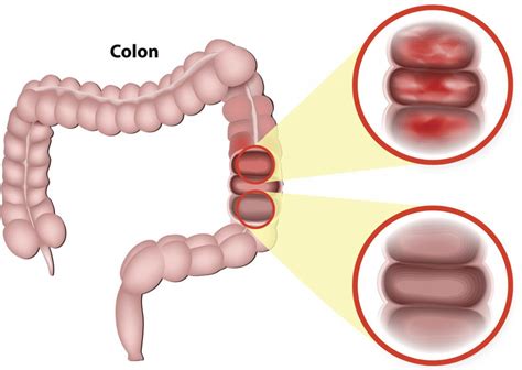 Left-sided colitis: Symptoms, diagnosis, and treatment