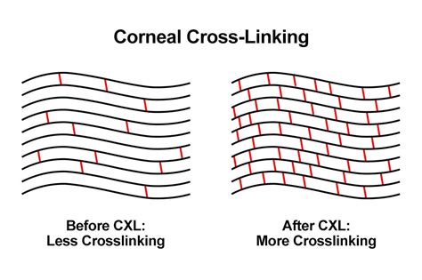 Corneal Cross-Linking - Washington, DC - Maryland - Virginia - HLV