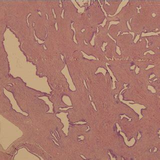 Salpingitis isthmica nodosa (SIN). Serous type gland on the... | Download Scientific Diagram