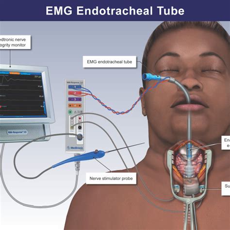 Endotracheal Intubation Vs Tracheostomy