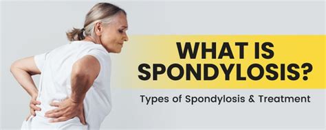 What Is Spondylosis? Types of Spondylosis & Treatment