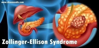 Zollinger-Ellison Syndrome or Gastrinoma- Causes, and Treatment