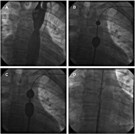 An unexpected complication during stent implantation for coarctation of ...