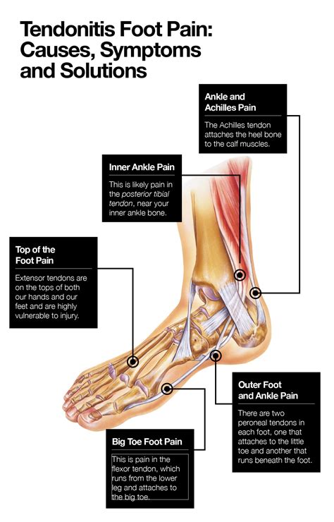 Tendonitis Foot Pain Causes Symptoms And Solutions The Amino Company | My XXX Hot Girl