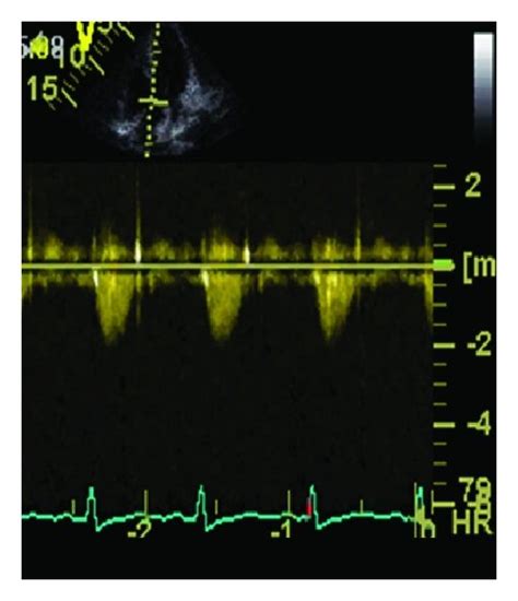 Echocardiographic aspect of HOCM before/after a myectomy ((a)–(d)) and ...