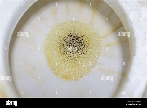 Close-up of foamy urine in the toilet. Foamy urine may be a sign of kidney disease. Photograph ...