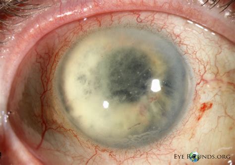 Atlas Entry - Delayed postoperative fungal endophthalmitis