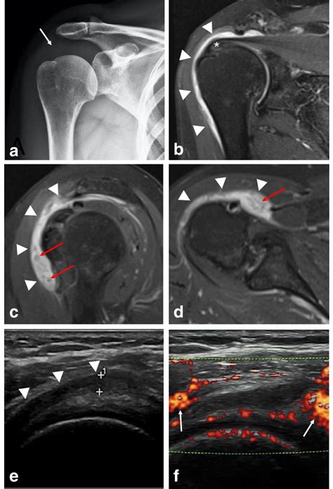 Subacromial Subdeltoid Bursitis Mri