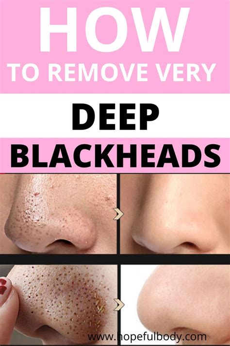 Best way on how to get rid of deep blackheads on the nose in 2020 ...